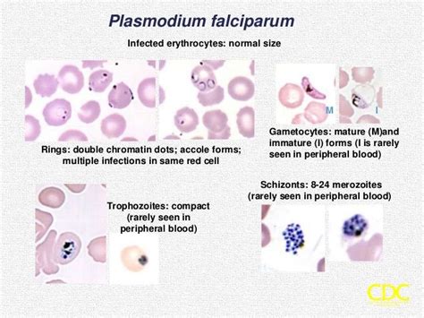 Lab Diagnosis Of Malaria Plasmodium Malaria Diagnosis Malaria