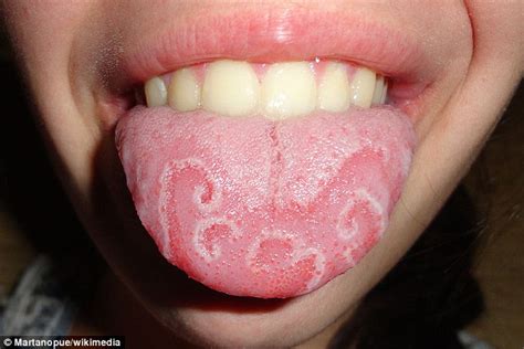 Do You Have Geographic Tongue Physicists Shed Light On Bizarre