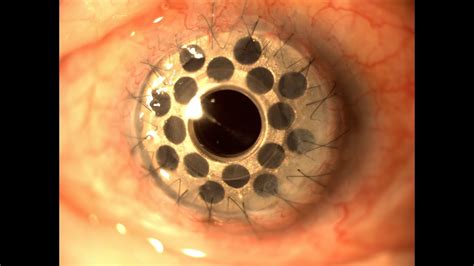 Trypophobia Eye Keratoprosthesis Viyoutube