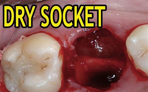 Normal Socket After Tooth Extraction With Pictures 2023 Go Fix Teeth