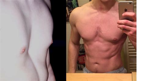 Pectus excavatum, or funnel or sunken chest, occurs in both children and adults. What is pectus excavatum ? - Surgery In India