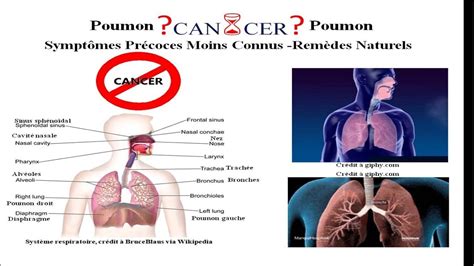Symptomes Cancer Du Poumon Stade 1 - Communauté MCMS™.