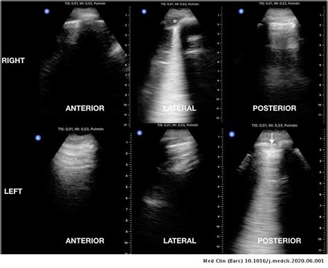 Lung Ultrasound In The Frontline Diagnosis Of Covid 19 Infection