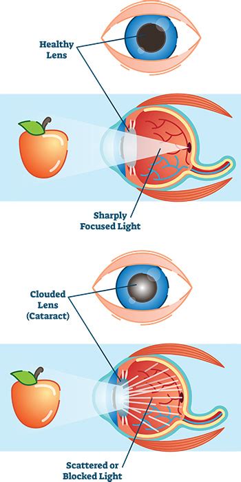 Can be found at : Cataracts - First Eye Care Downtown Dallas