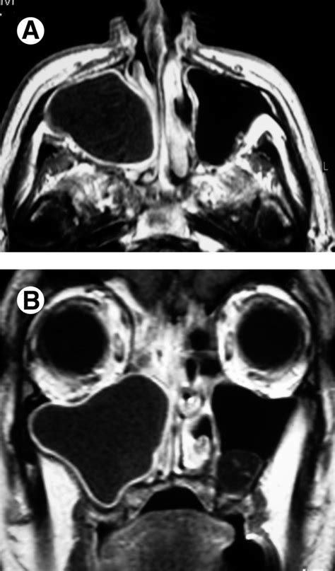 A Axial And B Coronal T1 Weighted Post Gadolinium Mri Demonstrating