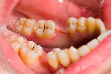 Have A Cavity Or Two Heres How You Can Heal Them Naturally