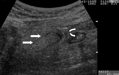 An Infrequent Cause Of Acute Left Lower Quadrant Abdominal