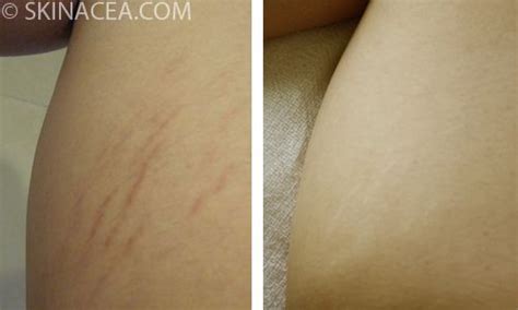 How To Get Rid Of Stretch Marks Stretch Marks Red