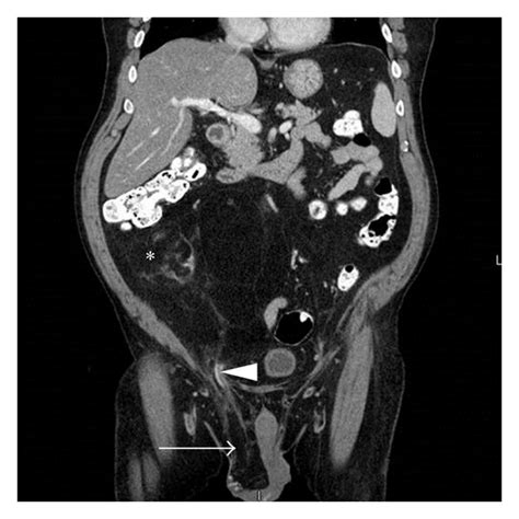 Ct Abdomen And Pelvis With Iv Contrast Transverse Image Displaying A