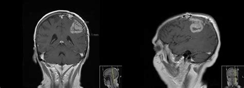 Cureus The Use Of 5 Ala In Glioblastoma Resection Two Cases With
