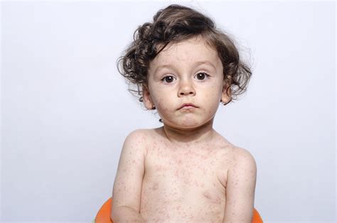 Mumps Measles Rubella And Chickenpox Your Health