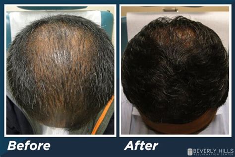 Low Level Laser Therapy For Hair Loss Bhrc Medspa Blog