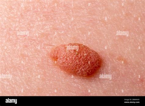 Large Mole Close Up Macro Shot Of Benign Skin Lesion On Caucasian