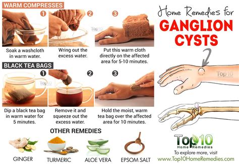 How To Get Rid Of A Ganglion Cyst Without Surgery Brandon Martin Kapsels