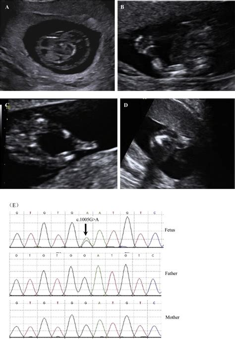 Cystic Hygroma And Micromelic Lower Limbs First Trimester Sonographic