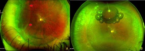 Secondary Pneumatic Retinopexy For Failed Scleral Buckle Bmj Case Reports