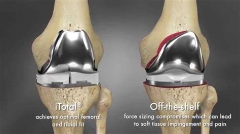 Itotal Knee Replacement Surgery Youtube