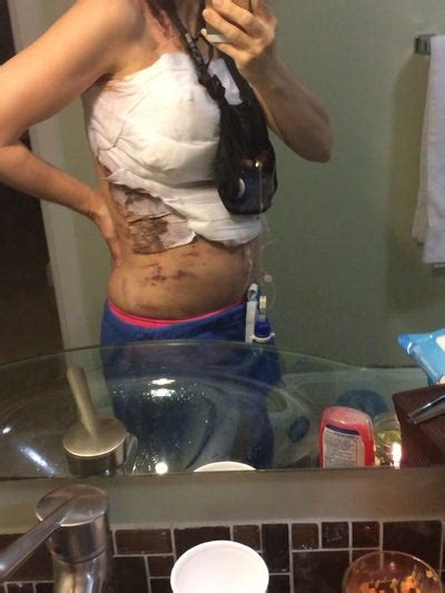 How much does fat transfer to breast cost. 38 Year-old Undergoes Implant Removal with Bilateral ...