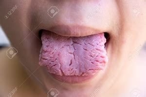 Although they are regularly dislodged during coughing and eating, and medical or. Contagious Tonsillitis Children Gums Sore Bleeding Swollen ...