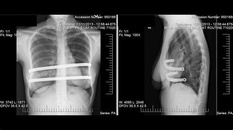 Pectus excavatum, also known as funnel chest or trichterbrust 13, is a congenital chest wall deformity characterized by concave depression of the sternum, resulting in cosmetic and radiographic alterations. Recovery From Pectus Excavatum Repair - YouTube
