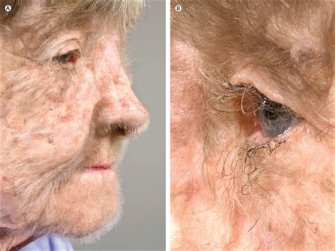 Women who have facial hairs commonly remove these by waxing or plucking. Hypertrichosis lanuginosa acquisita: a rare dermatological ...