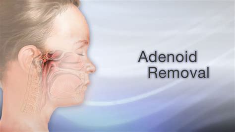 Adenoid Removal Maybe Your Child Snores A Lot Maybe Your Child Gets A