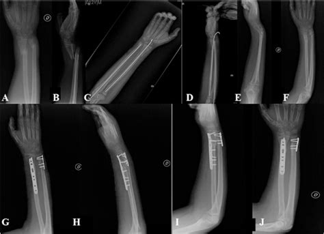 13 Year Old Male With Sports Trauma To The Right Wrist A B