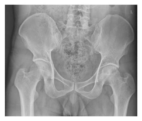 X Ray Picture Of Normal Position Of Pelvis Before Surgery Download