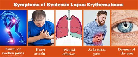 Systemic Lupus Erythematosus Sle Causes Symptoms Diagnosis And