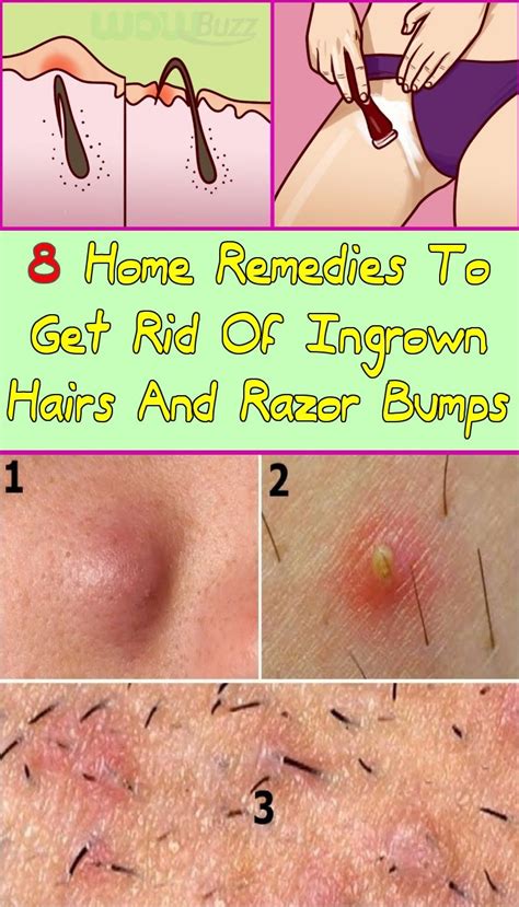 How To Get Rid Of Hair Bump Scars On Vag Hoch Biog Pictures Library
