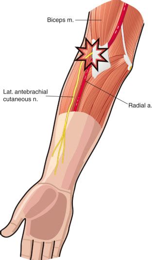 Lateral Antebrachial Cutaneous Nerve Entrapment At The Elbow