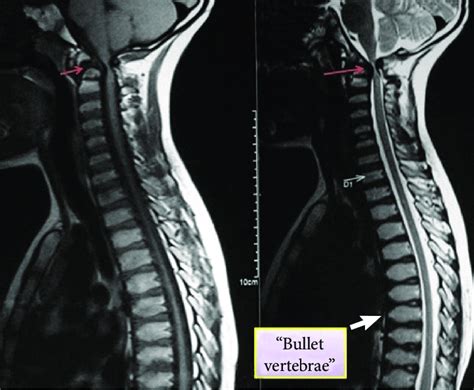 Sagittal T1 And T2 Weighted Magnetic Resonance Imaging Sequences