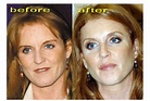 Sarah Ferguson Before and After Plastic Surgery Botox Injections and ...