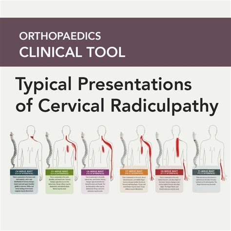 Typical Cervical Radiculopathy Presentations Cervical Radiculopathy