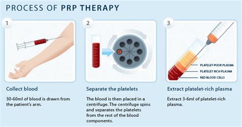 Desert Pain Specialists Now Offer Plasma Rich Platelet And Stem Cell