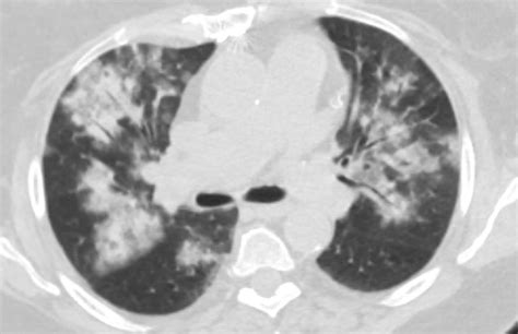 A Following Ct Scan Of The Chest Showed Extensive Patchy Bilateral