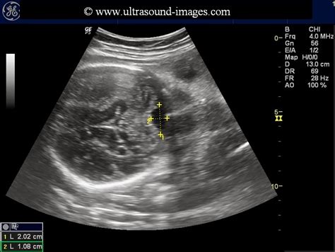 Ultrasound Imaging Prominent Fetal Cisterna Magna Or More Ominous