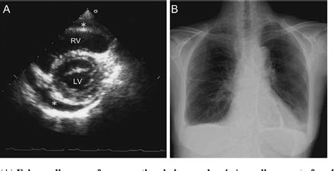 Figure From Acute Pericarditis In The Recovery Phase Of Transient