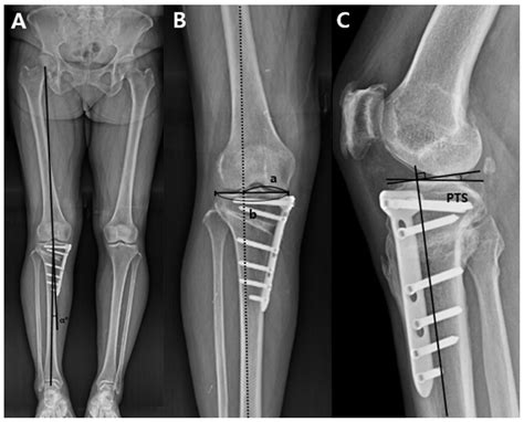 Jcm Free Full Text Effect Of The Osteotomy Inclination Angle In The