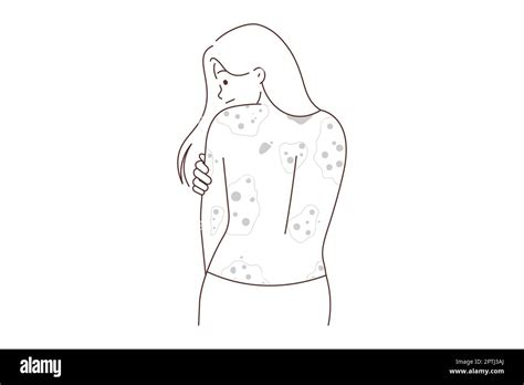 Unhealthy Woman Showing Red Rash On Back Suffer From Dermatitis Unwell