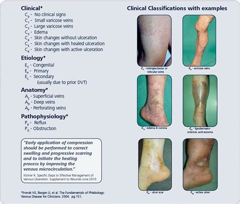 Vein Disease Classifications Texas Vein And Cosmetic Specialists