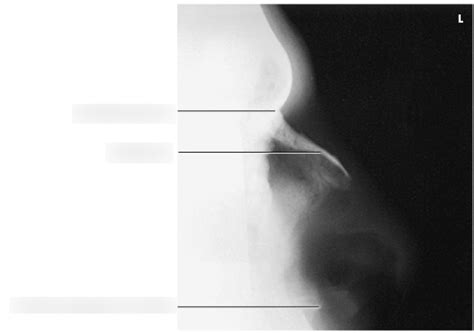 QUIZ Nasal Bones Lateral X Ray Diagram Quizlet