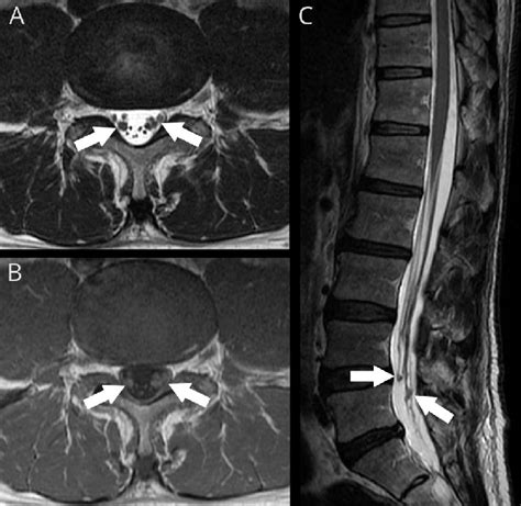 MRI illustrating cauda equina findings | Download ...