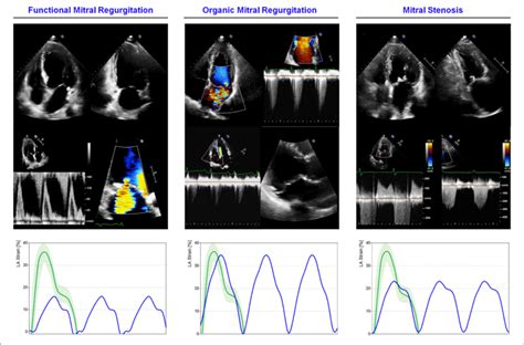 La Mechanics In Mitral Valve Diseases Examples Of Echocardiographic