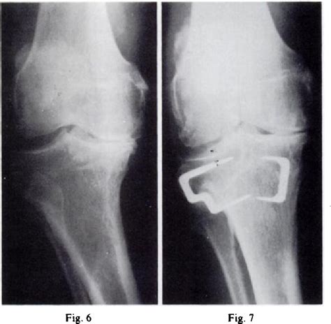 Figure 6 From Dome Osteotomy Of The Tibia For Osteoarthritis Of The