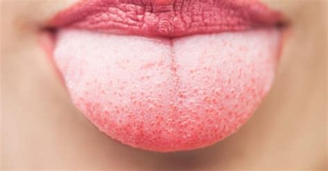 Il contagio può essere diretto (saliva) o indiretto (oggetti contaminati) e si cura con antibiotici. Colore e aspetto della lingua: ecco quando preoccuparsi