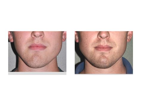 Asymmetrical Jawlines Causes And Treatments Justinboey