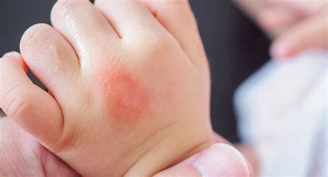 Insect Bites In Children Types Of Bug Bites And What To Do About Them