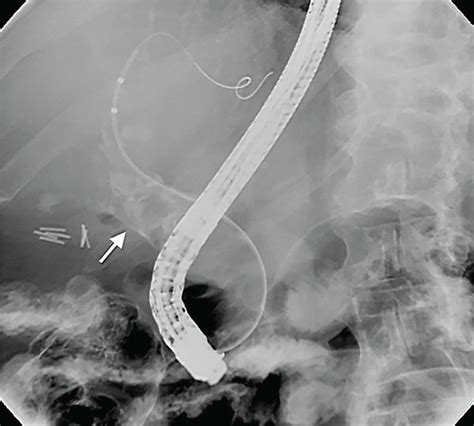 Ercp Demonstrating Radiolucent Filling Defects In A Dilated Cbd In A