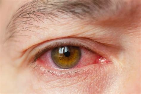 Conjunctivitis Pink Eye Causes Symptoms Prevention And Treatment